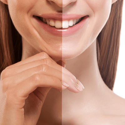 Woman smiling, showing the difference brushing, flossing and tongue cleaning makes