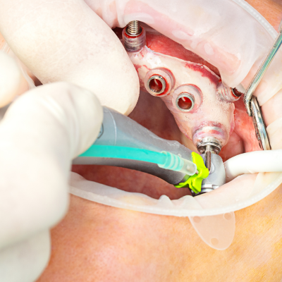 Close up of dentist doing guided implant surgery on mouth